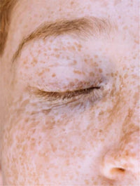 Targeted Dark Spot Care