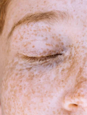 Targeted Dark Spot Care